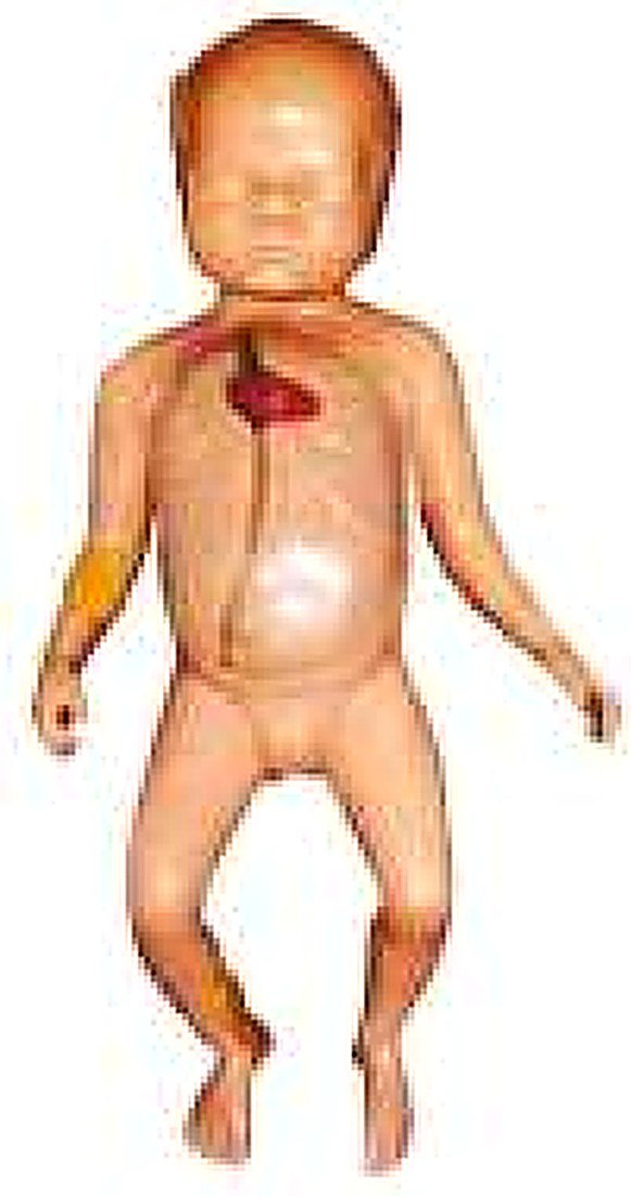ADVANCED NEONATAL PERIPHERAL AND CENTRAL VEIN INTUBATION SIMULATOR