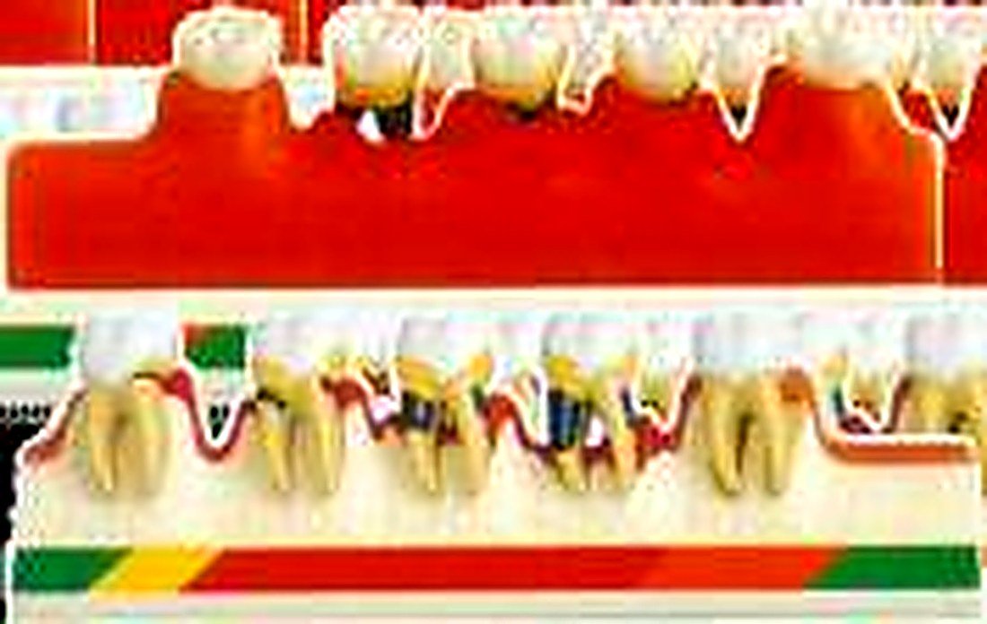 PERIODONTAL DISEASE MODEL - The model