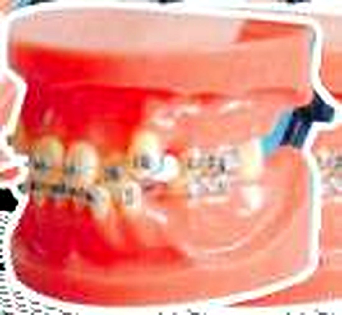 FIXED ORTHODONTIC MODEL (DISLOCATION) -