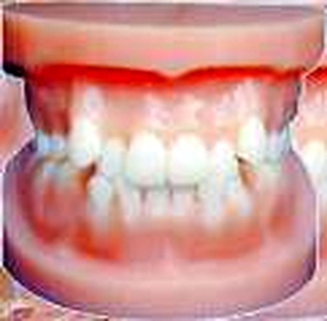 ORTHODONTIC MODEL - Shows the abnormal structure of crowded teeth, anti-jaw, protrusion, jaw opening, etc