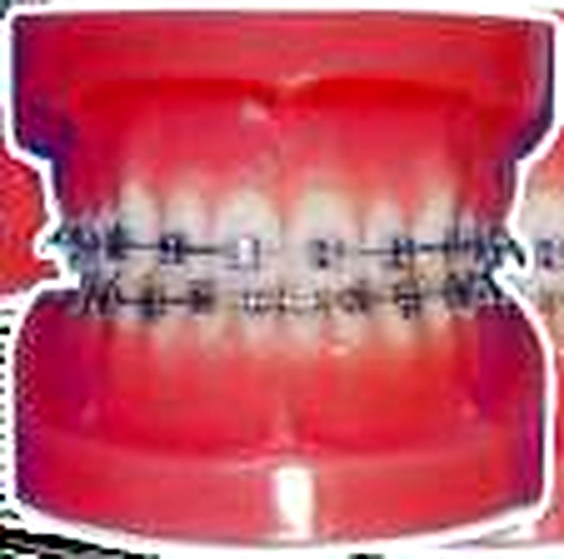 FIXED ORTHODONTIC MODEL (NORMAL) -