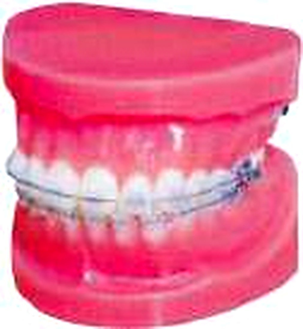 FIXED ORTHODONTIC MODEL (NORMAL) - alternate view