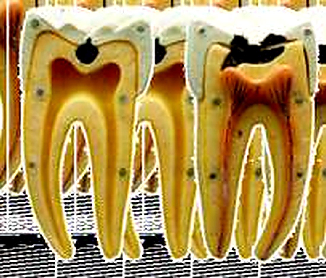 DENTAL CARIES MODEL - The model shows dental caries in initial and advanced stages. 16 positions are displayed. size 39x39x26 cms