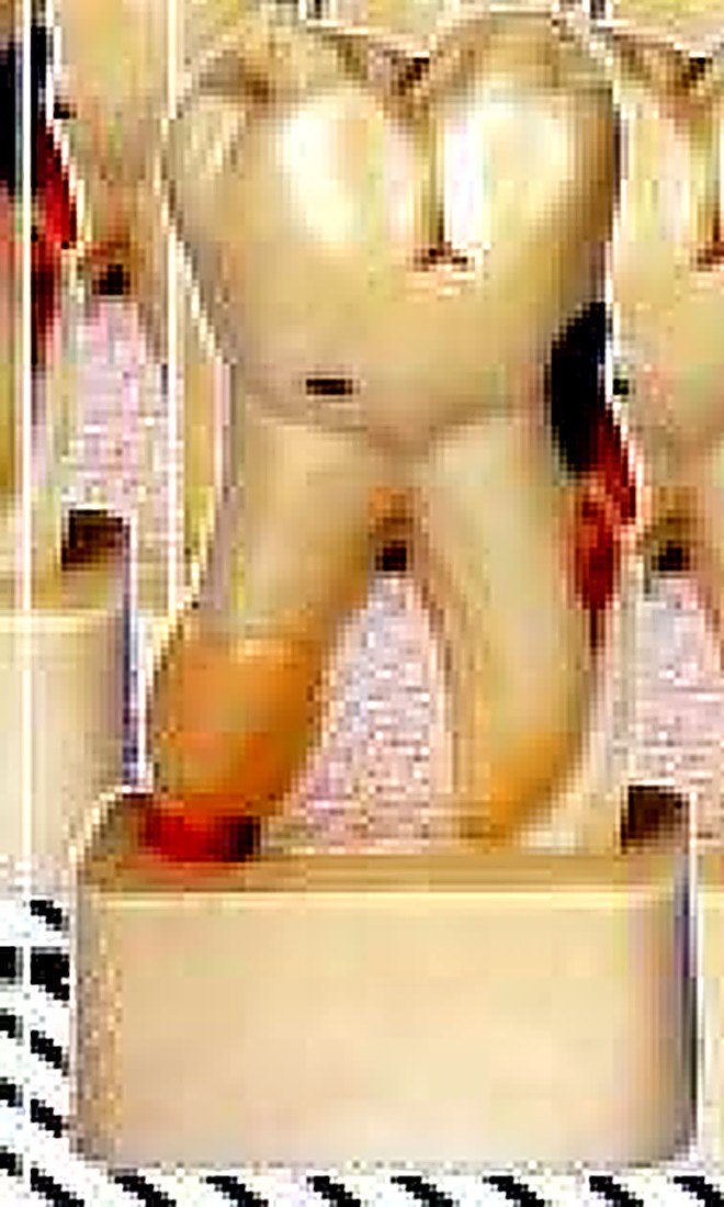 DISSECTED MODEL OF DENTAL DISEASE -