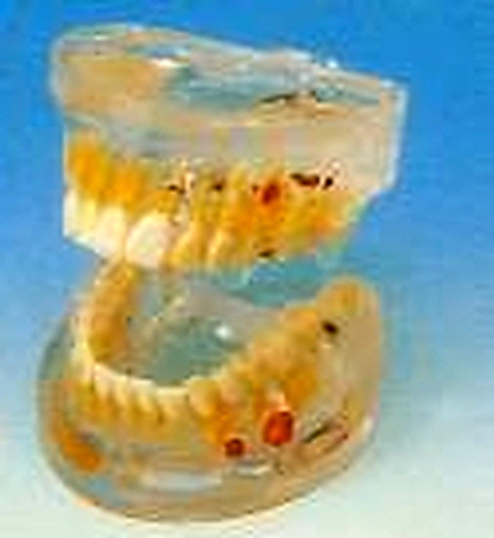 TRANSPARENT DENTAL PATHOLOGY MODEL -